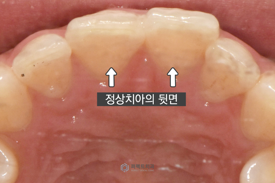 치아부식으로 크라운까지 하게 된 이유는? 관련 이미지 3