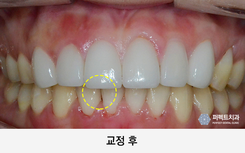 3개월 단기교정으로 빠르게! 관련 이미지 2