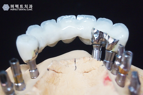 임플란트 건강보험 적용하면? 관련 이미지 5