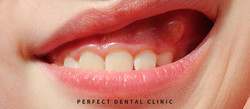 잇몸 물혹 예방방법 관련 이미지 1