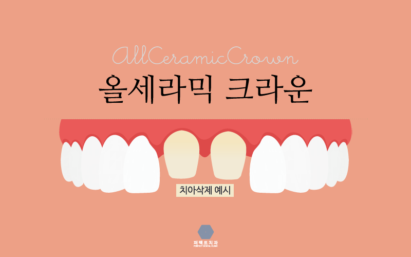 올세라믹 알아보고 있다면! 관련 이미지 2