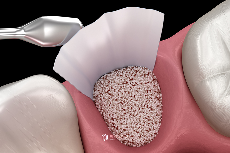뼈이식 임플란트, 뼈의 종류는?! 관련 이미지 2