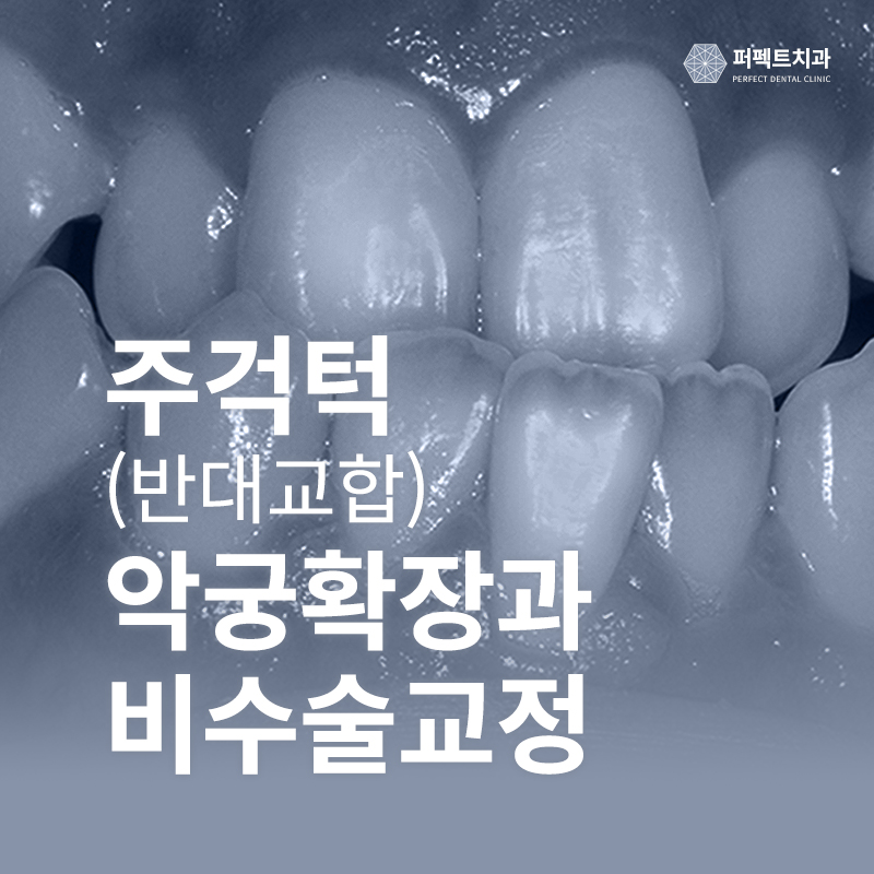 주걱턱, 좁은 위턱.. 콤비교정과 악궁확장장치 사용으로! 관련 이미지 1
