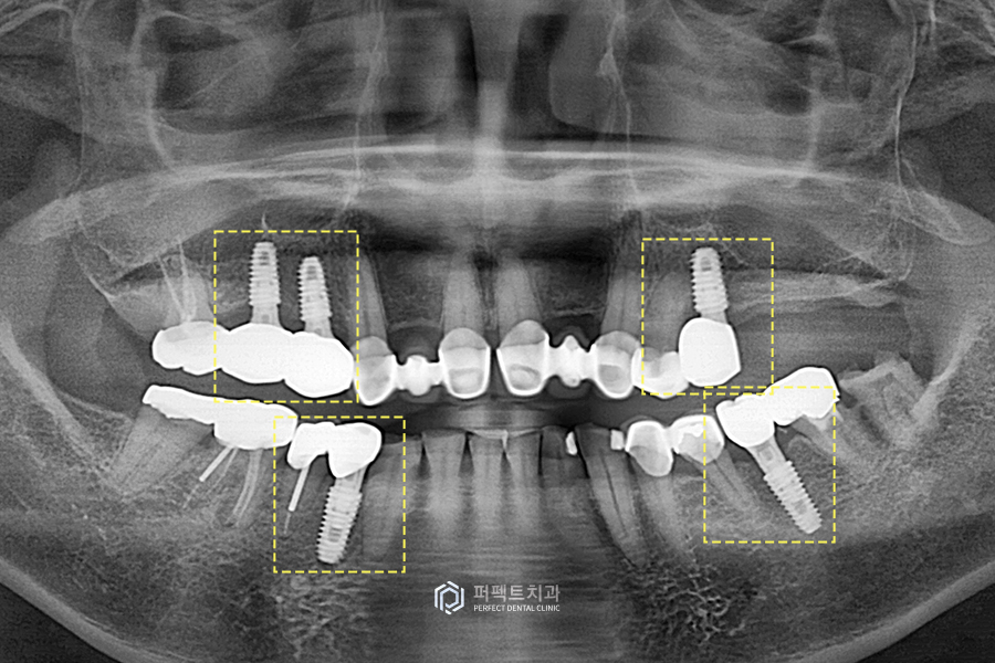 어금니가 없어 앞니로 음식을 드셨던..😰 어떻게 변했을까? 관련 이미지 4