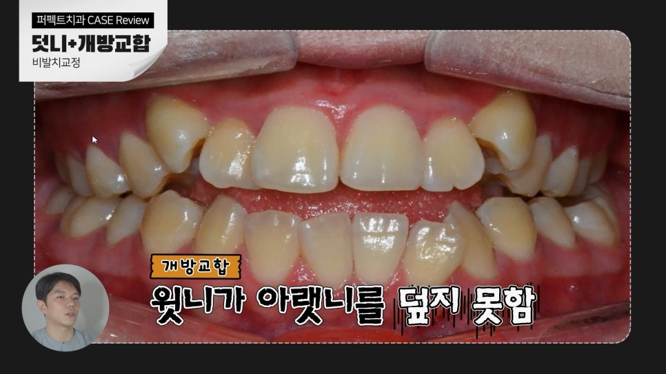 덧니+개방교합, MARPE를 이용한 비발치교정 관련 이미지 4