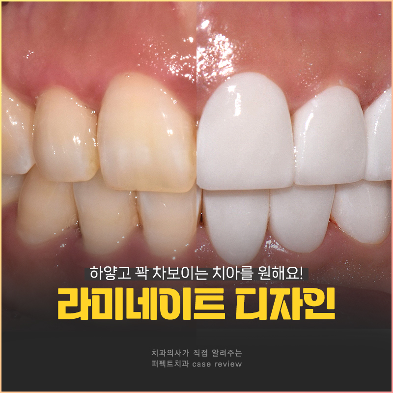 라미네이트 디자인👄｜치과의사가 고른 것vs환자가 고른 것, 어떤 걸로? 관련 이미지 1