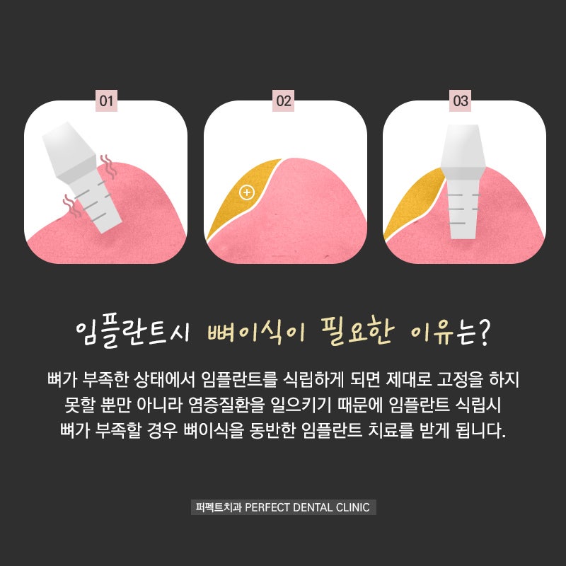 임플란트시 뼈이식이 필요한 경우 관련 이미지 3
