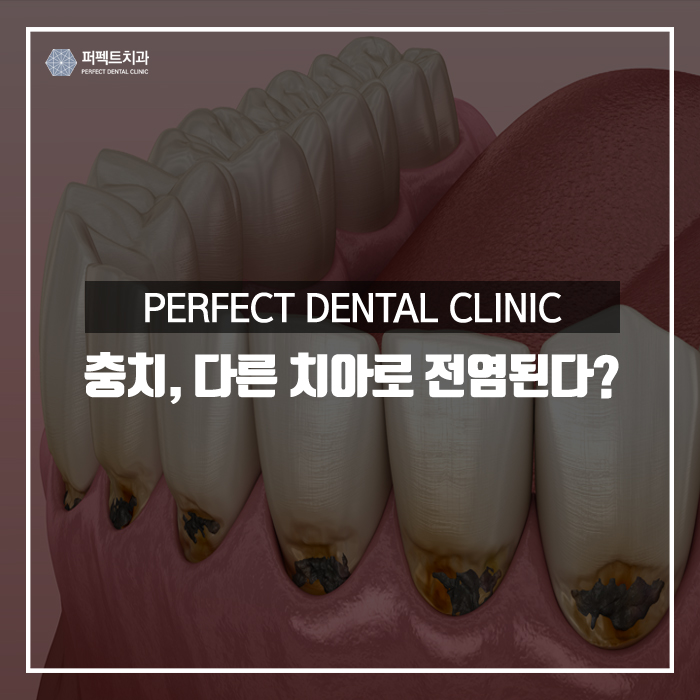 충치, 다른치아로 전염될 수 있다? 관련 이미지 1