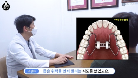 MARPE 악궁확장장치로 위턱 넓히기?! 관련 이미지 4