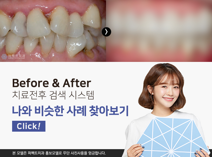 블랙트라이앵글, 치경부마모증 치과치료! 관련 이미지 5