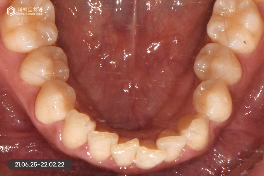 삐뚠 치아도 최소삭제가 가능하게👌🏻 교정 후 폴리네이트 관련 이미지 4