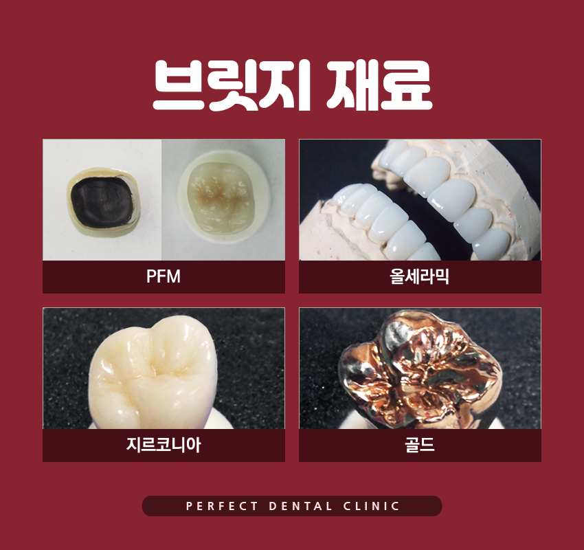 치아상실했을때 브릿지로? 관련 이미지 6