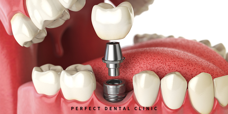 강남역 오스템임플란트 가격 관련 이미지 1