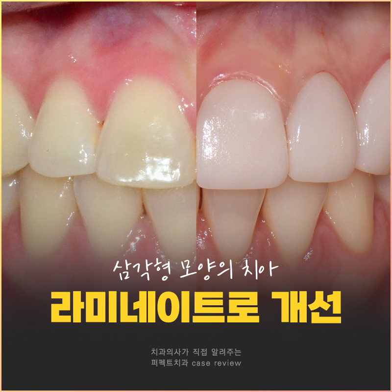 치아 모양 때문에 뻐드러져 보일 수 있다? 관련 이미지 1