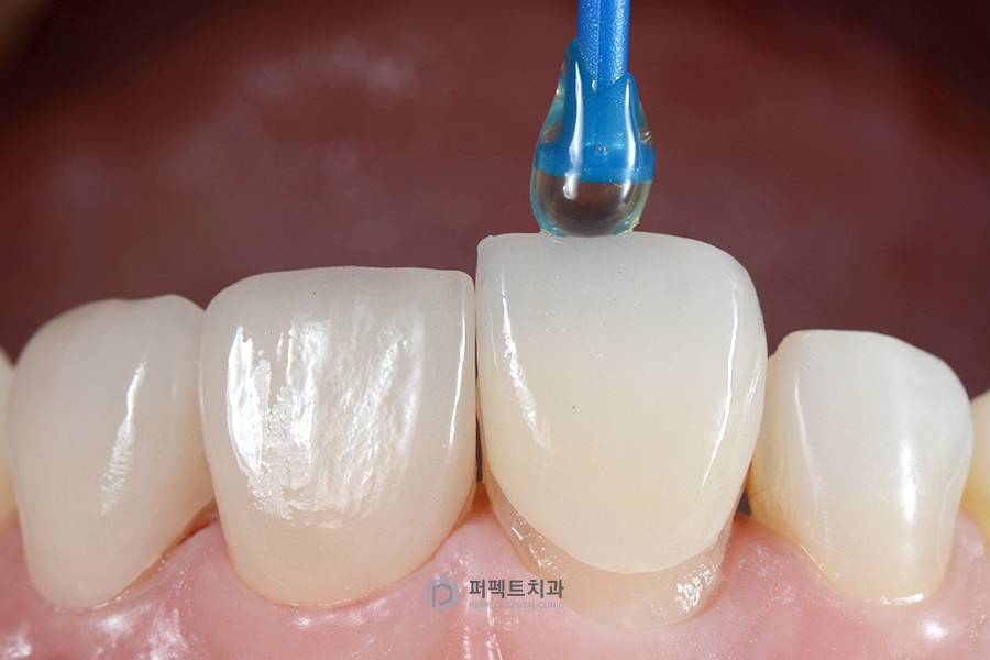 라미네이트 후 치실 사용 가능? 불가능? 관련 이미지 4