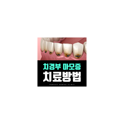 치경부마모증 원인과 치료방법! 관련 이미지 6