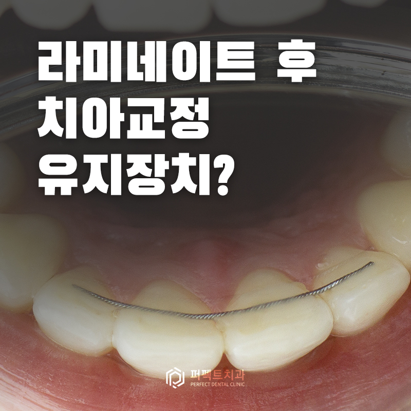 교정 후 라미네이트, 유지장치는? 관련 이미지 1