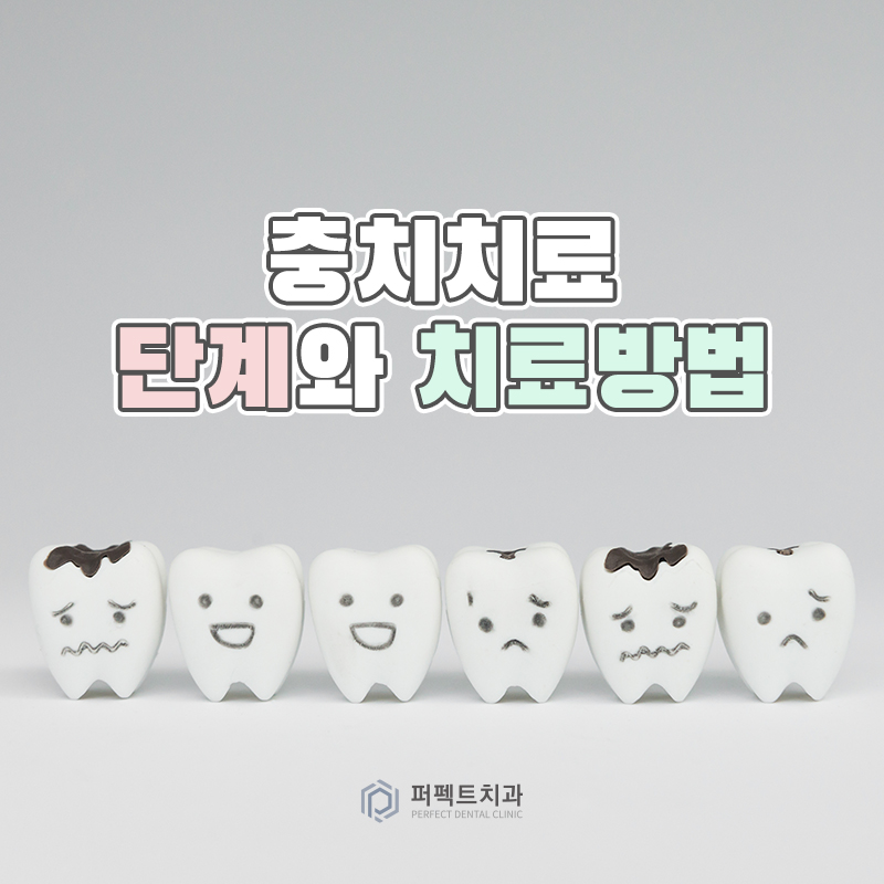 충치치료 단계와 치료방법 알아보기 관련 이미지 1