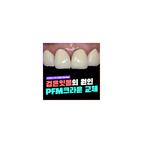 앞니 PFM크라운 가격 관련 이미지 3