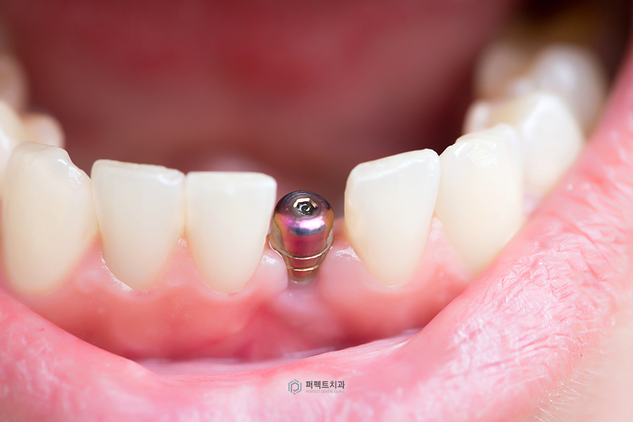 #3탄_의료보험 적용되는 치과치료는?(임플란트편) 관련 이미지 1