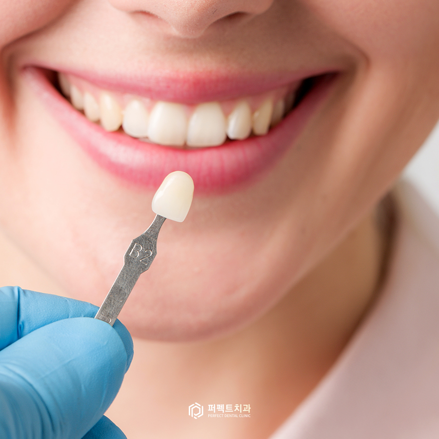 예쁜 라미네이트의 기준이 있나요? 관련 이미지 4