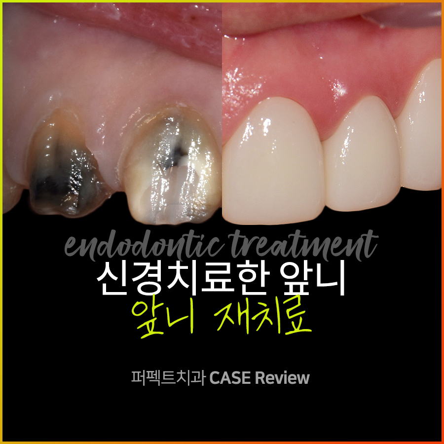 라미네이트를 뜯어보니😨..충격주의 #앞니신경치료 관련 이미지 1