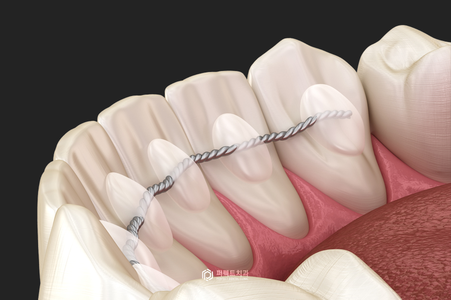 발치교정 한 부분에 틈이 벌어질 수 있을까요..? 관련 이미지 2