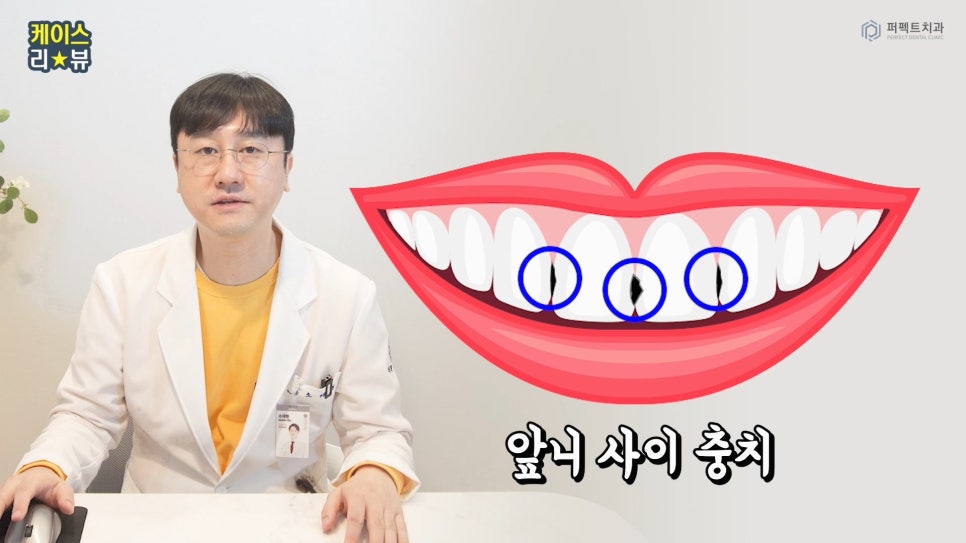 앞니 사이 충치, 최소삭제 라미네이트로! 관련 이미지 1