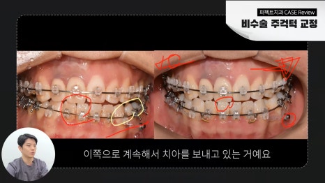 개방교합 주걱턱 교정 후기 관련 이미지 3