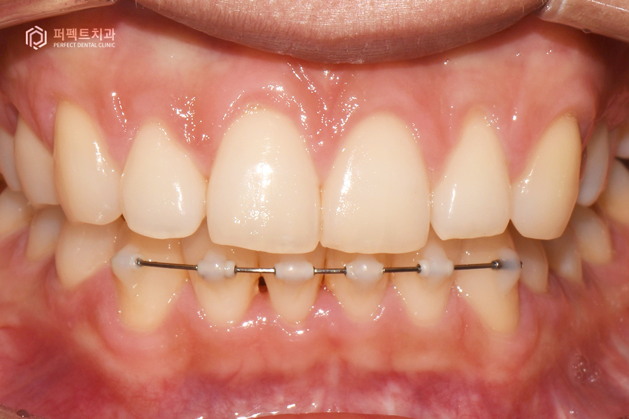 삐뚤거리는 아랫니를 6개월만에 반듯하게?! 관련 이미지 5
