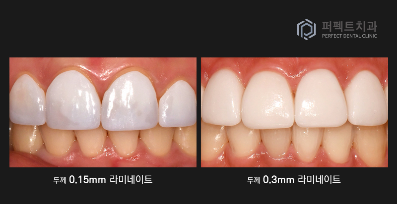 라미네이트는 무조건 얇을 게 좋을까? 관련 이미지 6