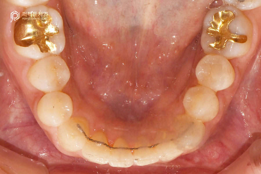 삐뚤거리는 아랫니를 6개월만에 반듯하게?! 관련 이미지 8