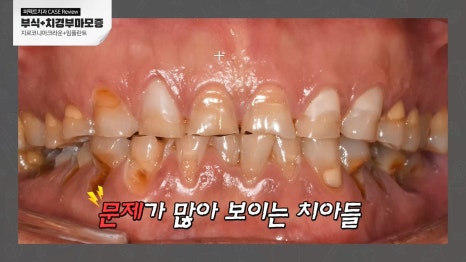 심한 치아 마모와 부식, 전악보철로! 관련 이미지 1