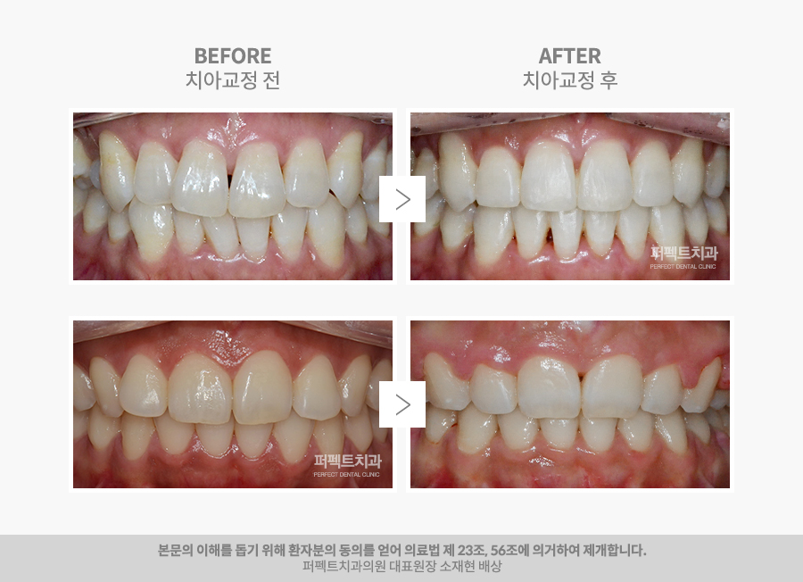 블랙트라이앵글, 치아교정의 부작용일까? 관련 이미지 4