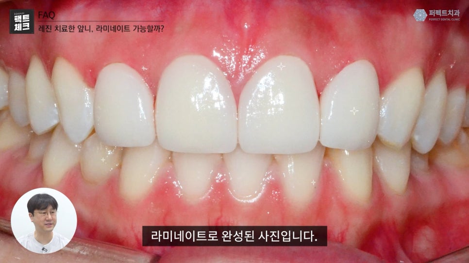 레진으로 치료받은 앞니도 라미네이트 가능한가요? 관련 이미지 6