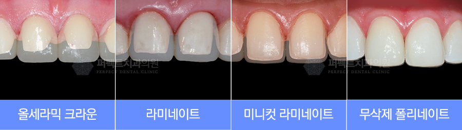 라미네이트 치료 시 참고사항은? 관련 이미지 3