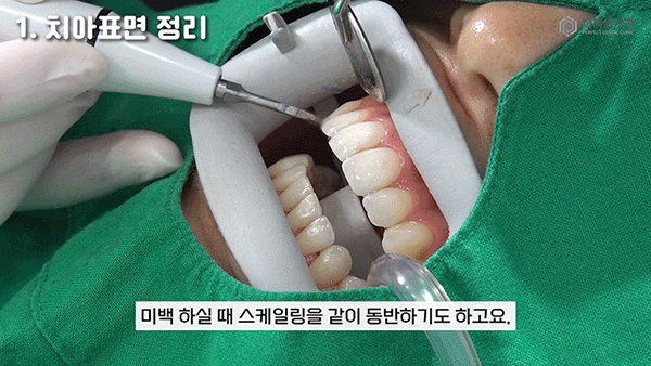 직접 받아본✨치아미백 과정① 관련 이미지 2