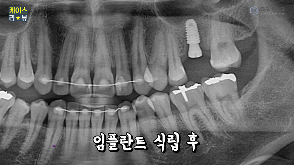 3분만에 임플란트를 할 수 있을까? 가이드임플란트 알아보기 관련 이미지 8