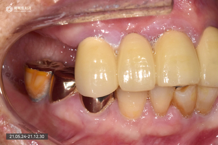 치아가 하나도 없을 때 필요한 전악임플란트😬 관련 이미지 3