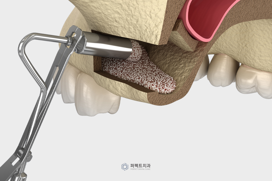 임플란트 시 꼭 뼈이식을 해야할까? 관련 이미지 2
