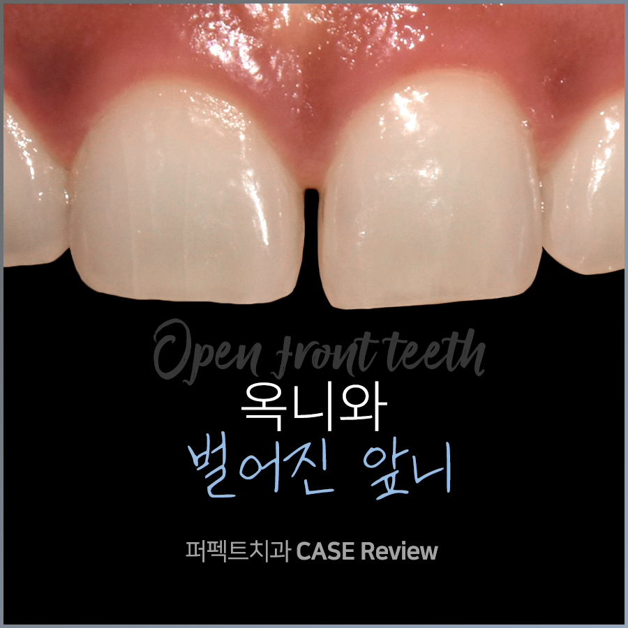 옥니, 벌어진 앞니 치료 결과는? 관련 이미지 1