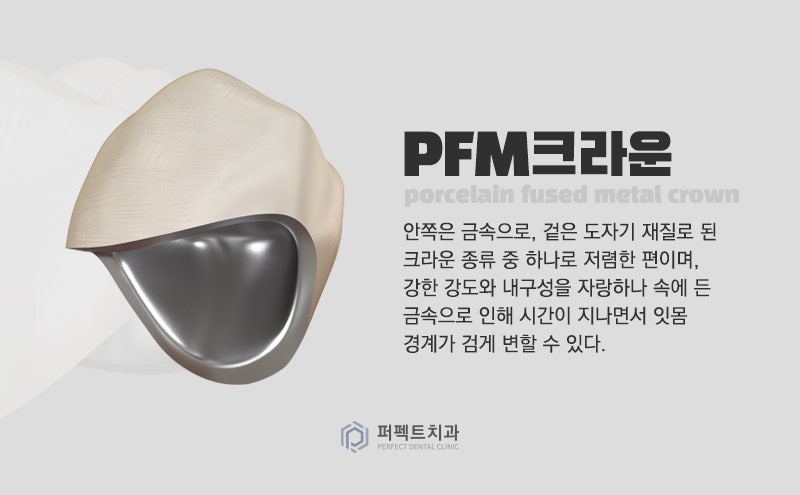 라미네이트시 신경치료 안해도 잇몸이 까매지나요? 관련 이미지 3