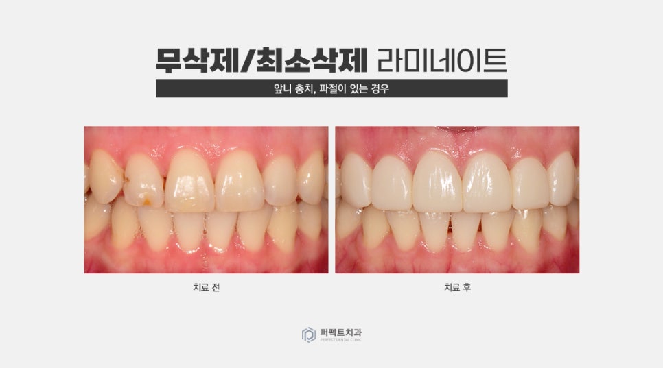 무삭제 라미네이트 추천 및 가능한 케이스 확인하기 관련 이미지 5