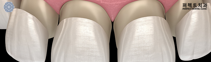 라미네이트 시술 후  주의사항 정리! 관련 이미지 3