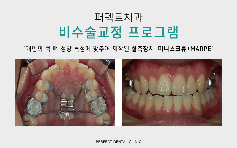 퍼펙트치과 전체교정 비용 궁금해? 관련 이미지 5