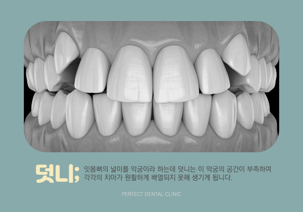 삐뚤빼뚤 덧니를 교정해야 하는 이유는? 관련 이미지 2