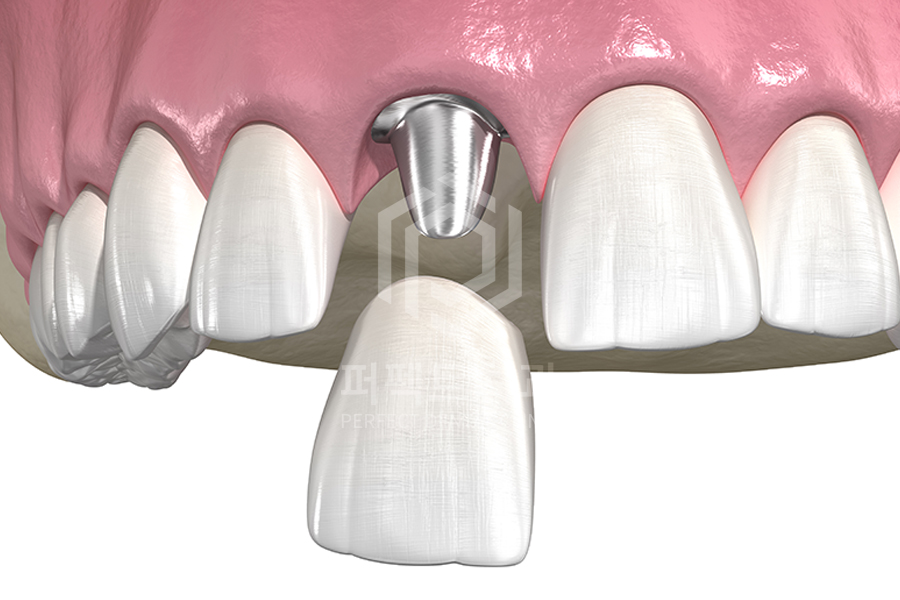 앞니 임플란트 후 잇몸이 까매진다? 관련 이미지 1