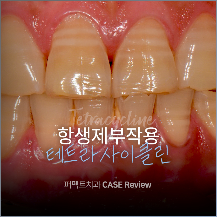 줄무늬 치아 테트라사이클린, 라미네이트vs치아미백 어떤 치료? 관련 이미지 1