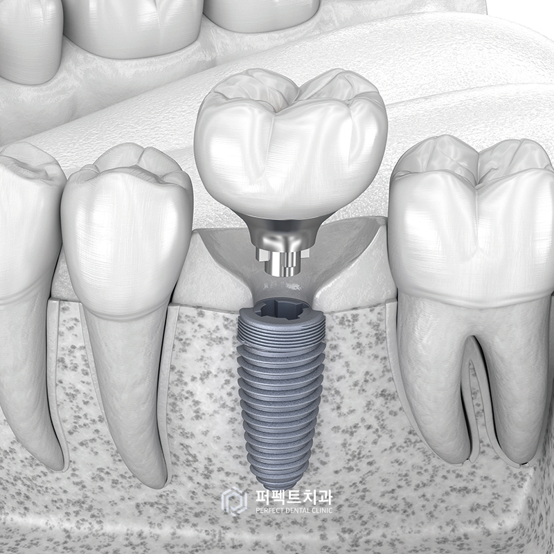 임플란트를 할 경우 발치한 공간은 비어있어야 하나요? 관련 이미지 3