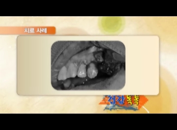 MTN 머니투데이 건강톡톡 / 치주질환과 뼈이식 임플란트 관련 이미지 8